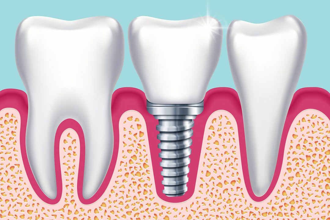 dental-tips-what-are-the-replacement-options-for-missing-teeth