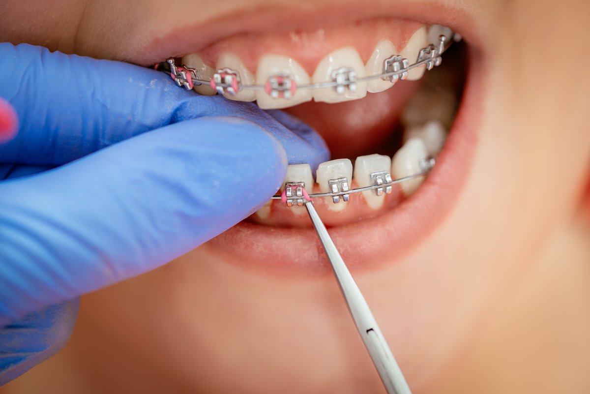 How Long Does It Take For Teeth To Shift With Braces - All information about Service