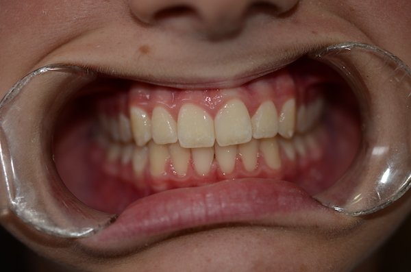 orthodontics case 1 after norlane geelong