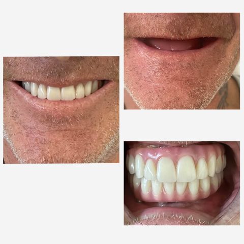 Dental Implants Norlane - Norlane Dental Aesthetics and Implants